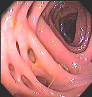 diverticulosis diseases